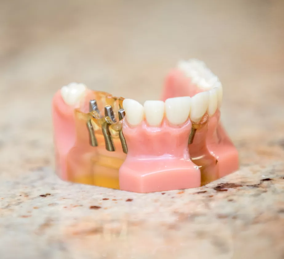 Dental Implants Dental Implants